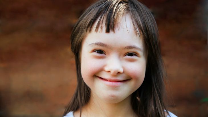 Kondisi Genetik Down Syndrome Pada Seseorang Anak