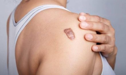 Jaringan Parut Keloid Pada Tubuh Yang Tumbuh