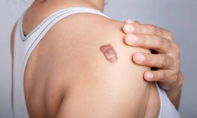Jaringan Parut Keloid Pada Tubuh Yang Tumbuh