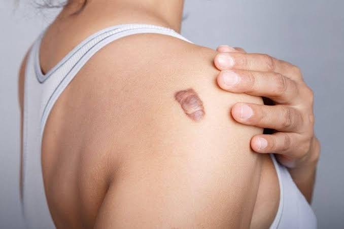 Jaringan Parut Keloid Pada Tubuh Yang Tumbuh